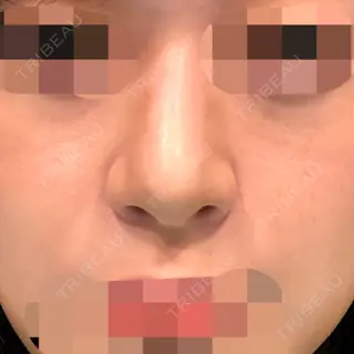 24日目の経過画像（1枚目）