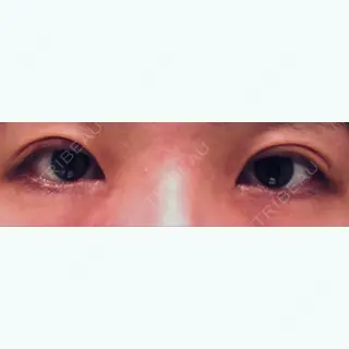 6日目の経過画像（1枚目）
