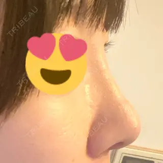 9日目の経過画像（2枚目）