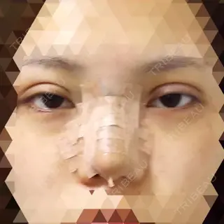 0日目の経過画像（1枚目）