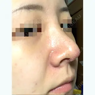7日目の経過画像（2枚目）