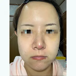 7日目の経過画像（1枚目）
