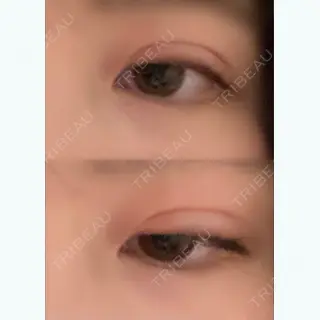 1日目の経過画像（1枚目）