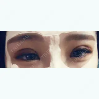 3日目の経過画像（1枚目）