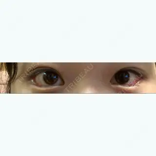 15日目の経過画像（1枚目）