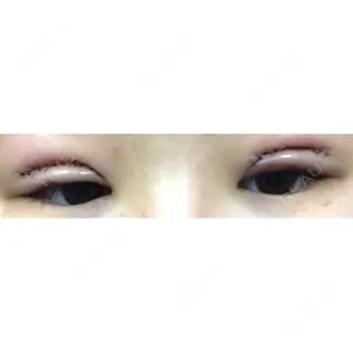 0日目の経過画像（1枚目）