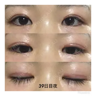 39日目の経過画像（1枚目）