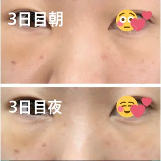 3日目の経過画像（1枚目）