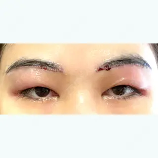 1日目の経過画像（1枚目）