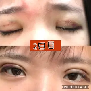 1日目の経過画像（1枚目）