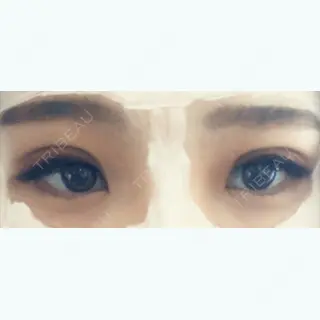 5日目の経過画像（1枚目）
