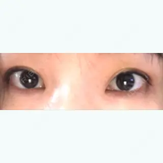 5日目の経過画像（3枚目）