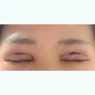 1日目の経過画像（2枚目）