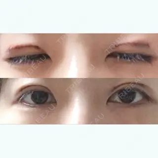 0日目の経過画像（1枚目）