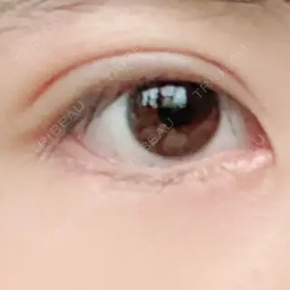 8日目の経過画像（1枚目）