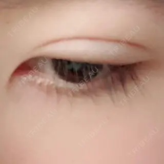 8日目の経過画像（2枚目）