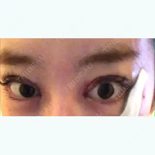 0日目の経過画像（2枚目）