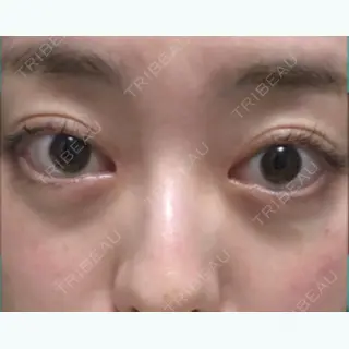43日目の経過画像（1枚目）