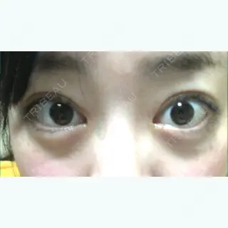 62日目の経過画像（1枚目）