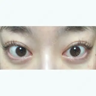 115日目の経過画像（1枚目）