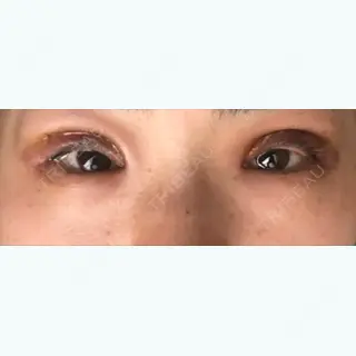 1日目の経過画像（1枚目）