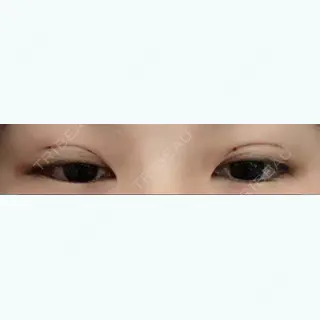 1日目の経過画像（2枚目）