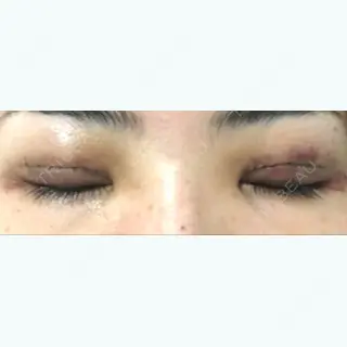 2日目の経過画像（3枚目）