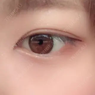 77日目の経過画像（3枚目）