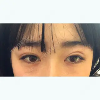 2日目の経過画像（1枚目）
