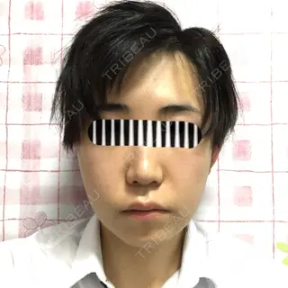 3日目の経過画像（1枚目）