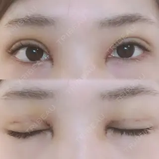 4日目の経過画像（1枚目）