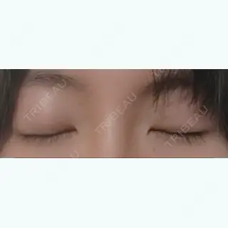 27日目の経過画像（3枚目）