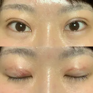 0日目の経過画像（1枚目）