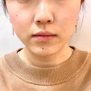 14日目の経過画像（1枚目）