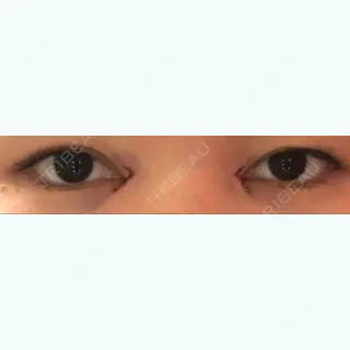 0日目の経過画像（1枚目）