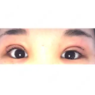 4日目の経過画像（1枚目）