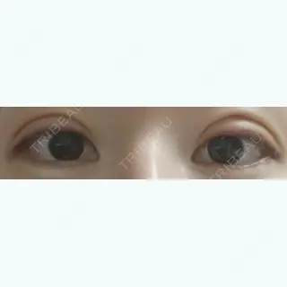 1日目の経過画像（1枚目）