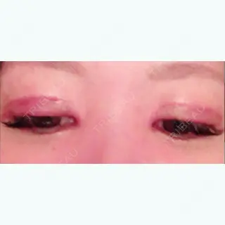 33日目の経過画像（2枚目）