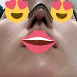 0日目の経過画像（3枚目）