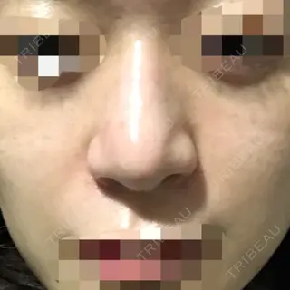 30日目の経過画像（1枚目）