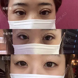 1日目の経過画像（1枚目）
