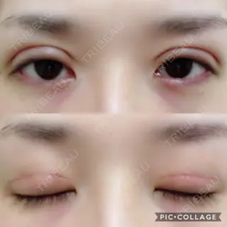 13日目の経過画像（1枚目）