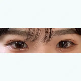 6日目の経過画像（1枚目）