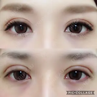 13日目の経過画像（2枚目）