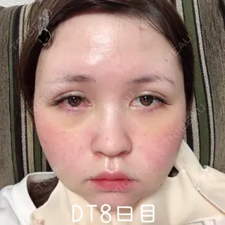 8日目の経過画像（1枚目）