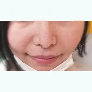 24日目の経過画像（1枚目）