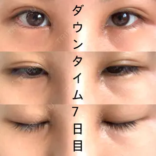 7日目の経過画像（1枚目）