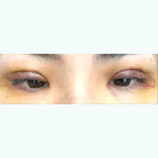 5日目の経過画像（2枚目）