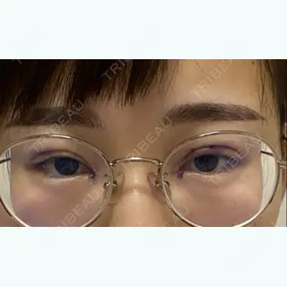 3日目の経過画像（1枚目）