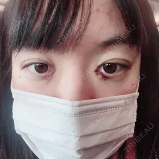 1日目の経過画像（1枚目）